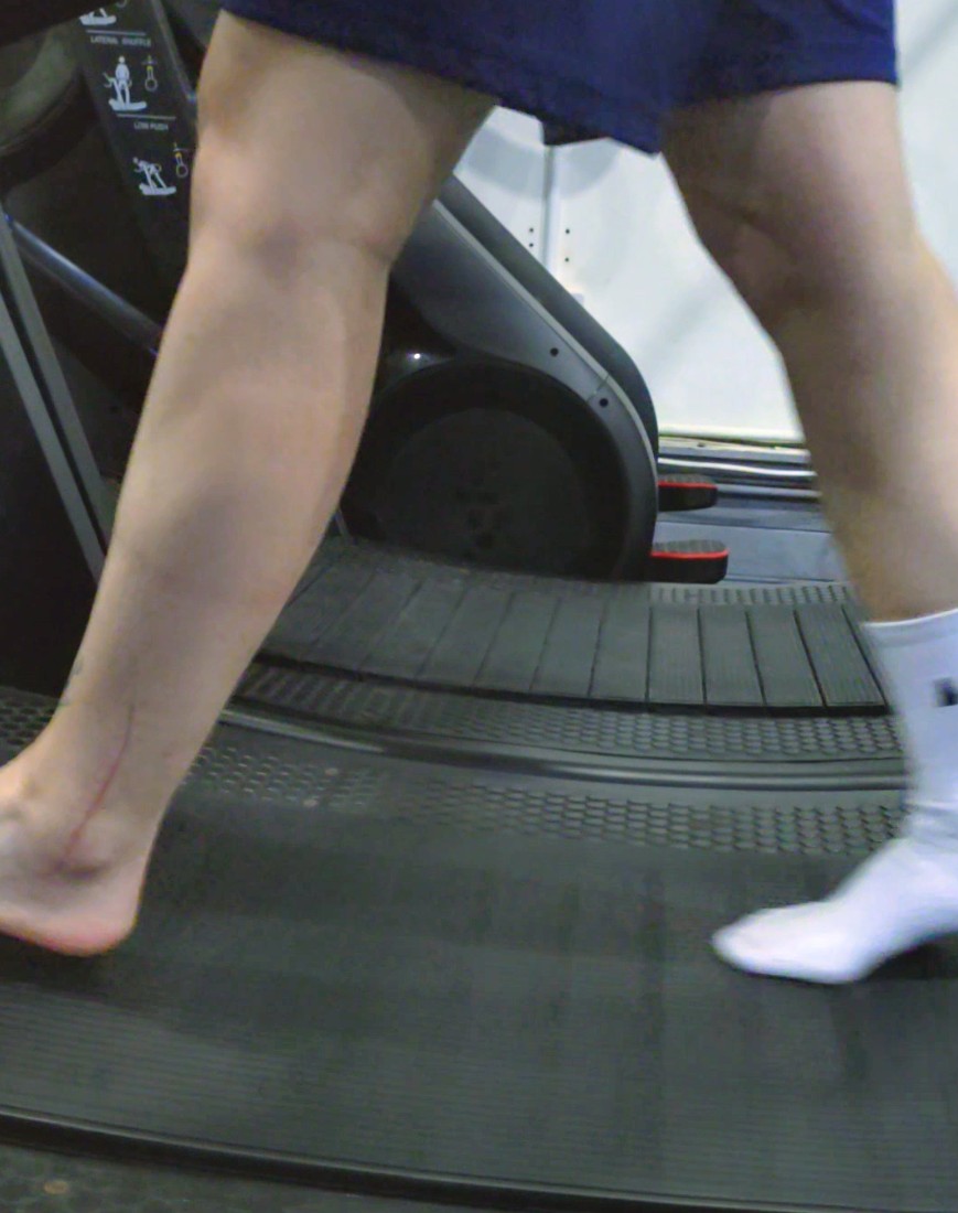 Gait analysis treadmill assessment evaluating biomechanics and lower limb movement patterns Sports rehabilitation exercise improving ankle mobility strength and functional recovery Physiotherapy assessment focusing on walking mechanics balance and injury prevention Musculoskeletal therapy analysing stride patterns for rehabilitation and performance optimisation Injury rehabilitation training targeting lower limb stability coordination and movement efficiency